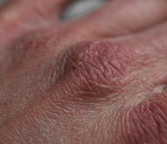 Natuurlijke hulpmiddelen tegen een droge en jeukende huid