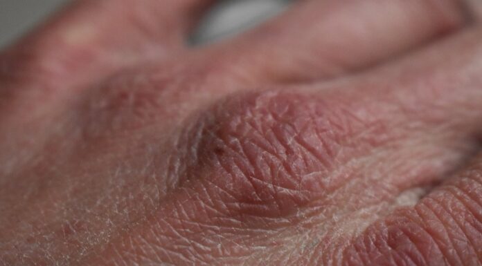 Natuurlijke hulpmiddelen tegen een droge en jeukende huid